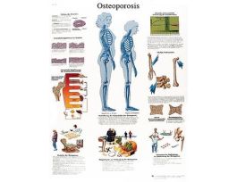 CHARTOSTEOPOROSIS