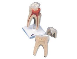 MODEL UPPER TRIPLE ROOT MOLAR
