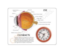 MODEL CATARACT EYE