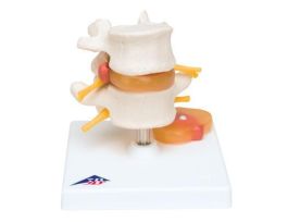 MODEL LUMBAR SPINE W/PROLAPSED DISC