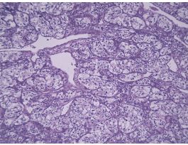 HUMAN KIDNEY CARCINOMA (SECT) H&E SLIDE