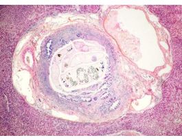 CLONORCHIS SINENSIS H&T LIVER FLUKE