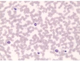 EOSINOPHILIA(SM)GS(HOMO)PERIPHERAL BLOOD