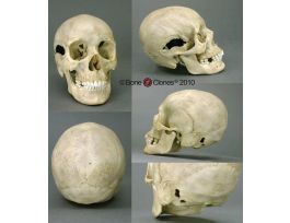 22 CALIBER WOUND SKULL