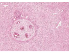 SCHISTOSOMA MANSONI-LIVER H&E SHOWING