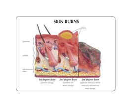 MODEL SKIN BURNS