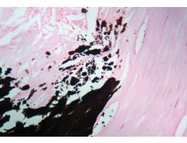 VON KOSSA KIT 100RXN