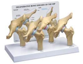 MODEL ARTHRITIC HIP 4 STAGES