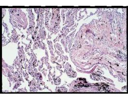 ANTHRACOSIS (SECT) HUMAN SMOKER'S LUNG