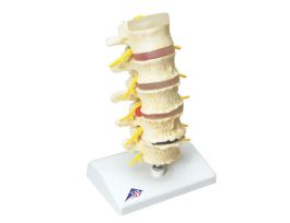 MODEL STAGES OF DISC PROLAPSE