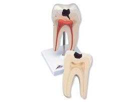 MODEL LOWER TWIN ROOT MOLAR
