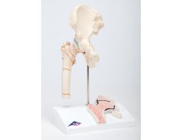 MODEL FRACTURE FEM+ HIP OSTEO