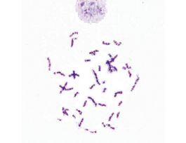 HUMAN CHROMO-TRISOMY 21 47 XX +21(SM)GS