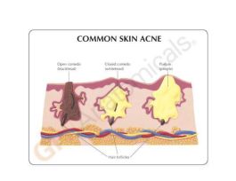 MODEL SKIN ACNE