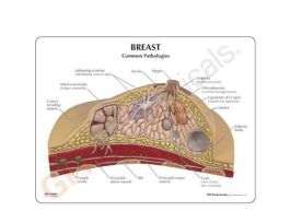 MODEL BREAST CROSS SECTION CANCE