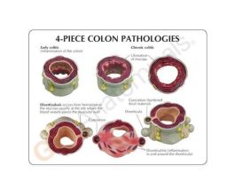 MODEL COLON PATHOLOGIES