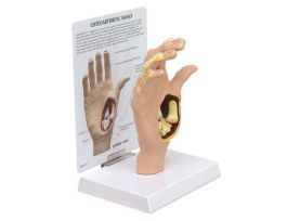 MODEL OSTEOARTHRITIS HAND
