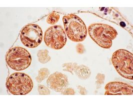 ECHINOCOCCUS GRANULOSUSHYDATIDCYST H&T