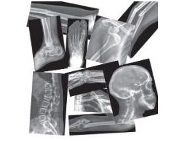 BROKEN BONES X-RAYS 15 PCS CS