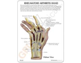 MODEL RHEUMATOIDARTHRITIS HAND