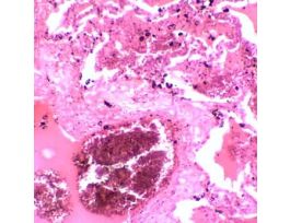 Prepared Slide, Human Lung Tissue, Diseased