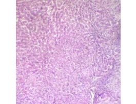 Prepared Slide, Human Liver Cells, Cirrhosis