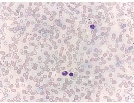 IRON DEFICIENCY: ANEMIA (HUMAN)