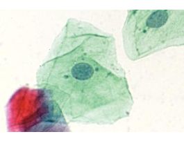 BARR BODIES (SM) CV SQUAMOUS EPITHELIAL