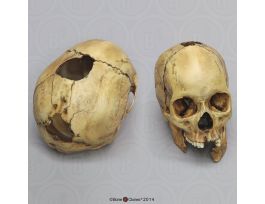 SHOTGUN WOUND SKULL