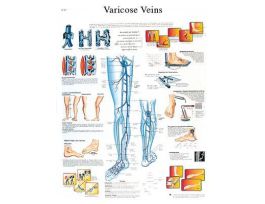 CHART VARICOSE VEINS