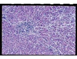 CIRRHOSIS (SECT) H&E (HUMAN) LIVER