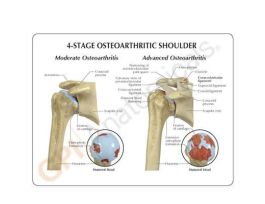MODEL 4STAGE OSTEOARTHRITIS SHOULDER