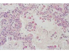HUMAN LUNG-2ND AIDS INFECTION PAS