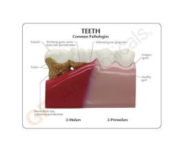 MODEL TEETH PATHOLOGIES