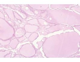 GOITER (SECT) H&E SLIDE (HUMAN) THYROID.