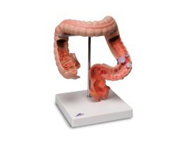 MODEL INTESTINAL DISEASES