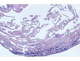 EMPHYSEMA (SECT) H&E SLIDE (HUMAN) LUNG.